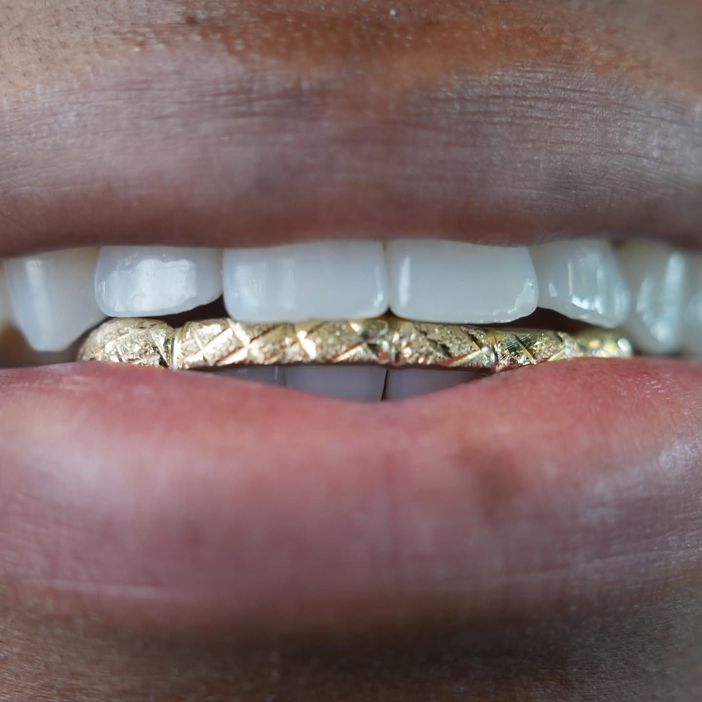 Custom 10K Gold Grillz